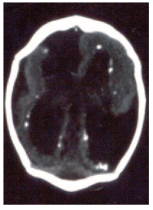 Gambaran CT Scan Kepala pada Infeksi CMV Kongenital